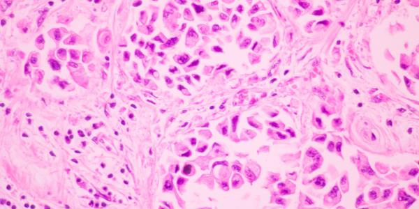 Section tissue of breast cancer view in microscopy. Ductal cell carcinoma. Tones of pink