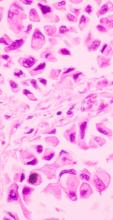 Section tissue of breast cancer view in microscopy. Ductal cell carcinoma. Tones of pink 