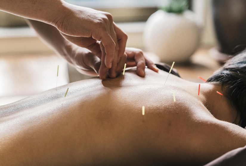 Person receiving acupuncture treatment in back