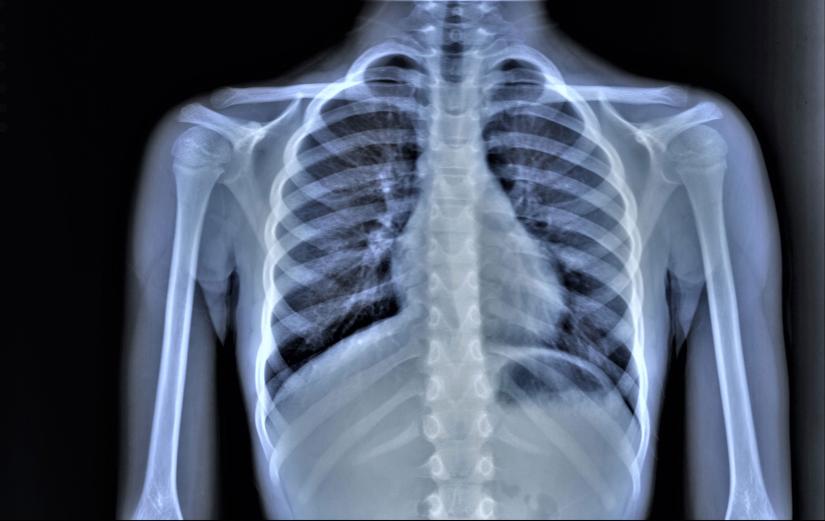 chest x-ray, pneumonia, emphysema, pulmonology, diagnosis of diseases. Picture: Anton/Adobe Stock