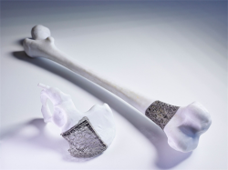 "Just-in-time implants"