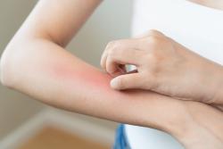 Image of arm with red mark and other hand scratching red area